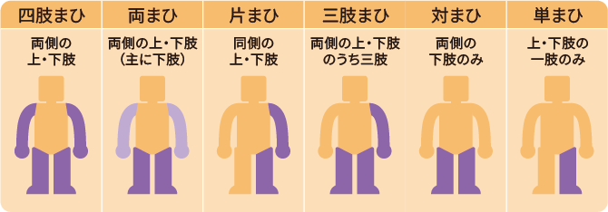 表:障害部位別のタイプ